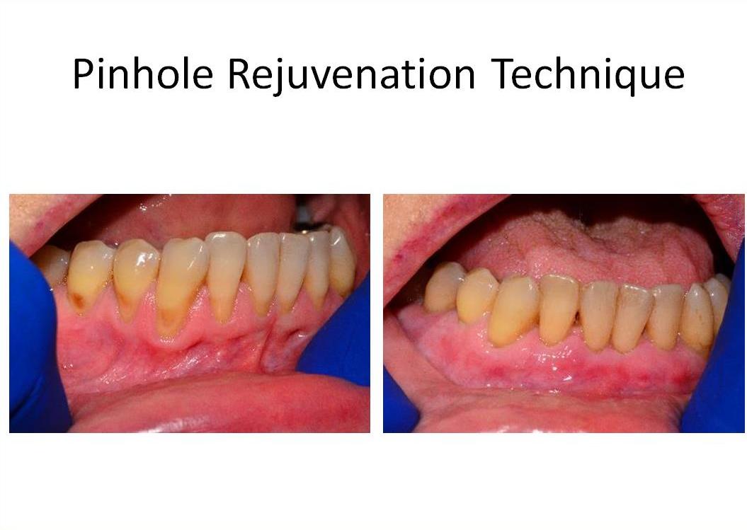 Dr Robert L Franklin Jr Pinhole Technique Pst Before And Afters 8591